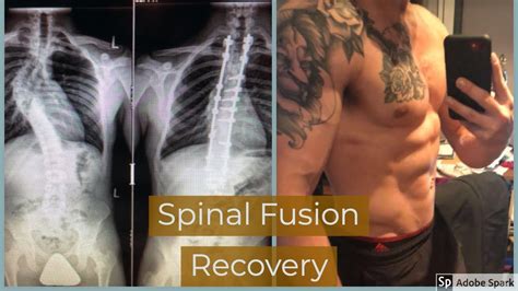 Spinal Fusion Surgery | My Story + Tips For a Full Recovery! - YouTube