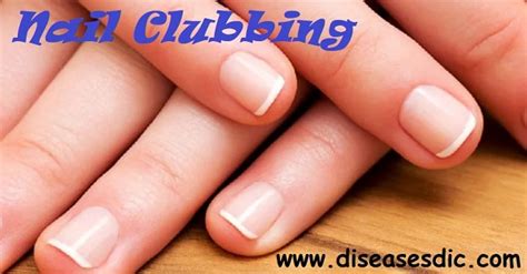 Nail Clubbing – Causes, Symptoms, and Treatment.