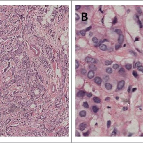 Histology of the resected mastectomy specimen ( H & E, original ...