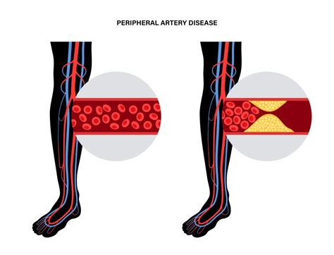 Know The Causes of Thrombosis | Add More to Life - Meril