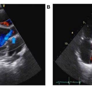 | Preoperative transthoracic echocardiography (TTE) showing severe ...