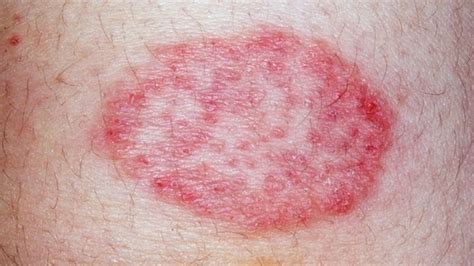 Leukemia Symptoms Red Spots Leukemia Rash Pictures Symptoms And ...