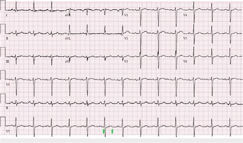 Initial EKG on day one showing normal sinus rhythm and normal QTc ...