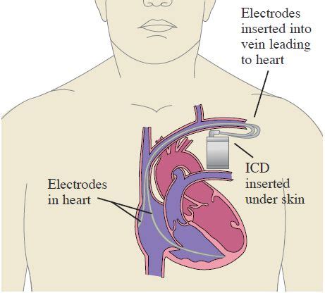 Icd - Cardiac Device Features Icd Features Medtronic / List of 495 best ...