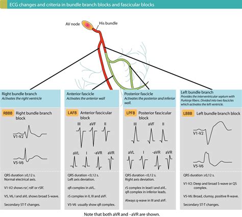 Intraventricular conduction delay: bundle branch blocks & fascicular ...