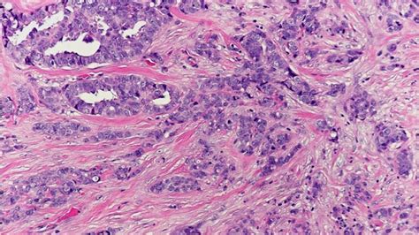 Invasive Ductal Carcinoma Histology