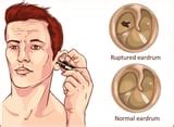 Tympanic Membrane Perforation: Symptoms, Causes, and Treatment Options