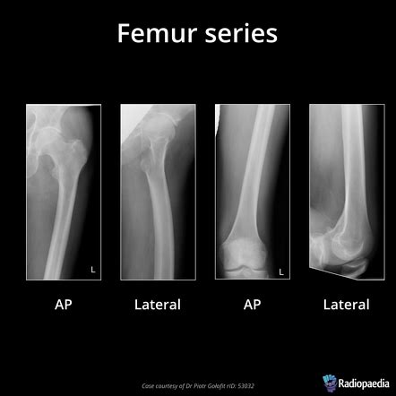 Femur Radiographs