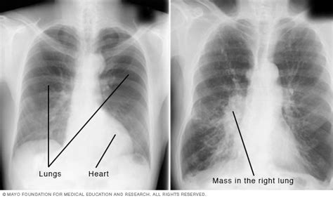 X-ray: Imaging test quickly helps find diagnosis - Mayo Clinic