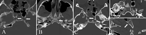 Bone window of CT scan showing transverse clival fracture subtypes ...