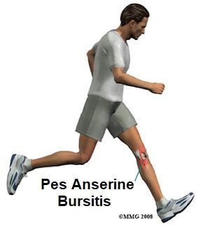 Pes anserine bursitis treatment - subtitleweek