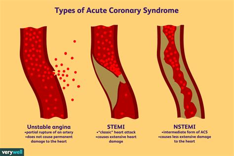 Stemi Vs Nstemi Diagram