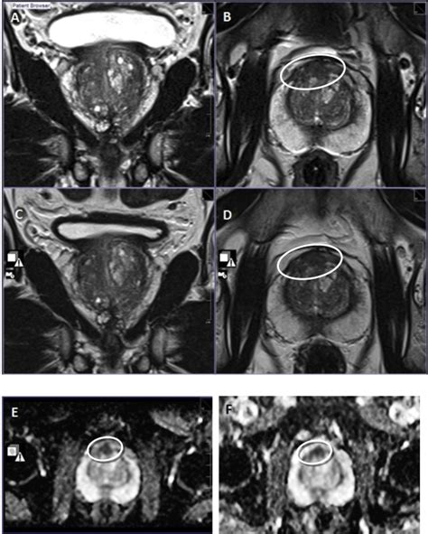 Multiparametric Magnetic Resonance Imaging for the Detection of ...