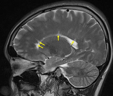 Dawson fingers (multiple sclerosis) – Radiology Cases