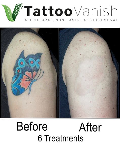 Color Tattoo Removal Before And After