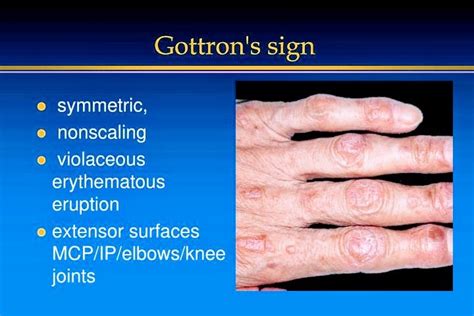 Symptoms of Dermatomyositis - PT Master Guide