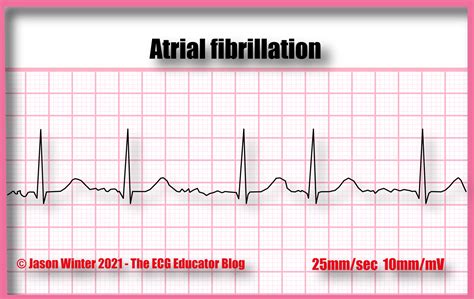 Atrial Fibrillation Ecg