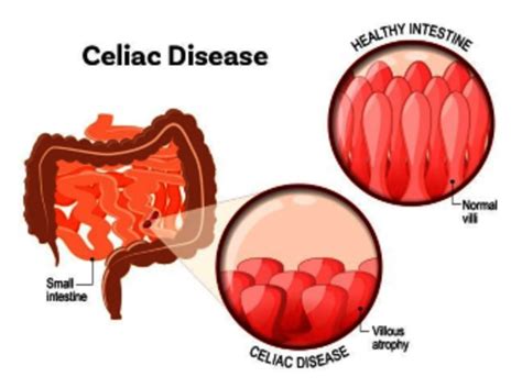 Celiac disease - DaineSalmah