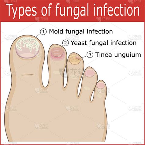 真菌感染的类型