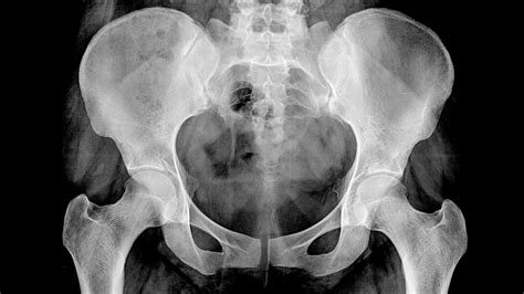 Osteoarthritis Hip X Ray Findings