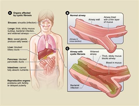 Cystic Fibrosis - Symptoms | NHLBI, NIH