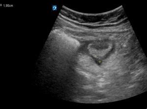 RIF pain - Critical Care Sonography