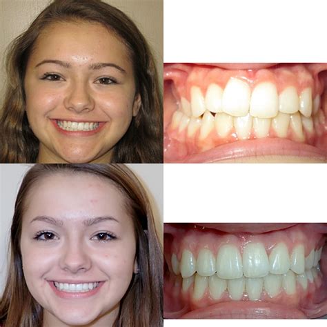 Before & After Braces | Wazio Orthodontics