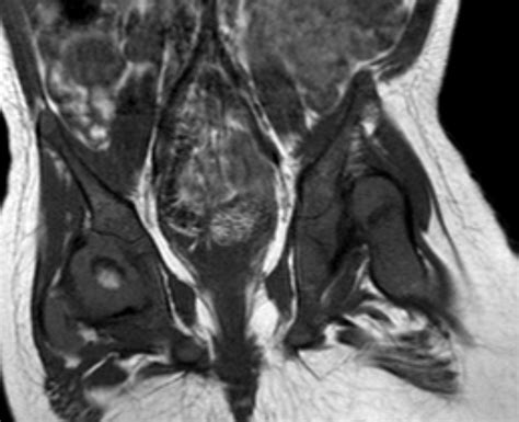 Developmental Hip Dysplasia-MRI - Sumer's Radiology Blog