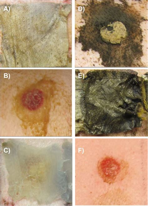 Pseudomonas Aeruginosa Burn Infection