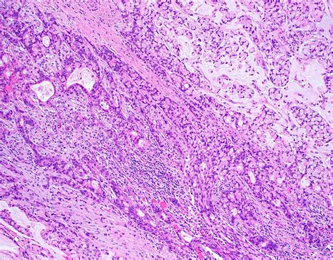 Pathology Outlines - Goblet cell adenocarcinoma