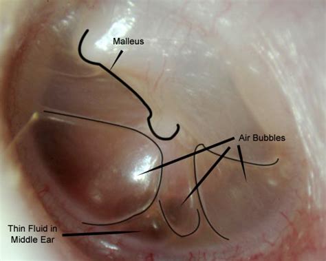 Fluid in the ear Images | McGovern Medical School