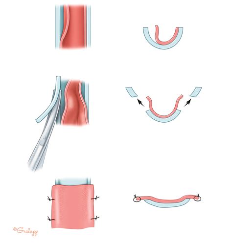 Postauricular Meatoplasty – Oto Surgery Atlas