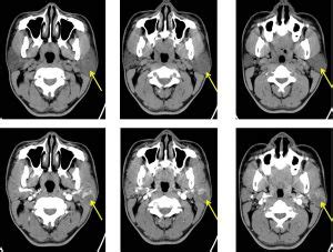 Pleomorphic adenoma of parotid gland – Radiology Cases