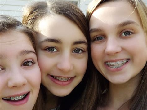 Young Girls With Braces On Teeth – Telegraph