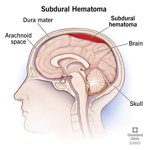 Subdural Hematoma: What It Is, Causes, Symptoms & Treatment