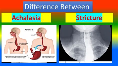 Difference between Achalasia and Stricture - YouTube