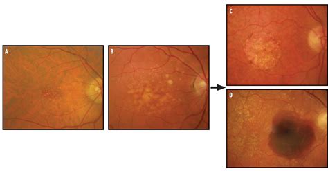 Rethinking Our AMD Nomenclature - Retina Today