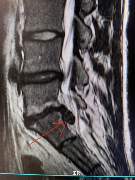 Just my huge L5-S1 disc extrusion reminding you to sit up straight ...