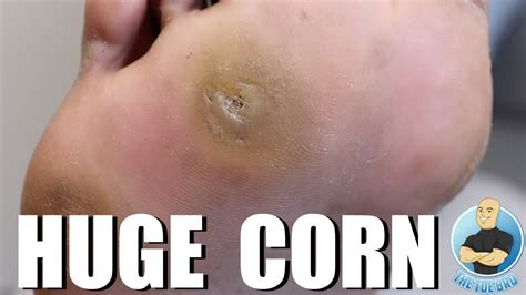 HUGE FOOT CORN REMOVAL TREATMENT - YouTube