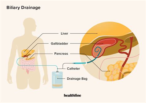 Bile Duct Drain: Purpose, Procedure, Effectiveness, and Outlook