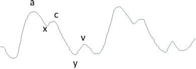 Abnormal Cvp Waveform