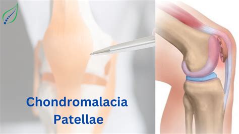 Chondromalacia Patellae: Causes, Symptoms & Treatment | Best Back Pain ...