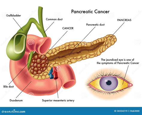 Pancreatic cancer stock vector. Illustration of irritability - 36554219