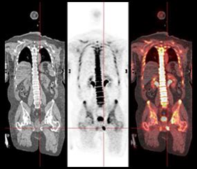 Bone Scan Los Angeles | Optima Diagnostic Imaging