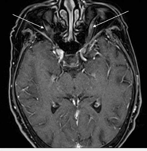 Patient's head MRI with abnormal enhancement of optic nerves. MRI ...