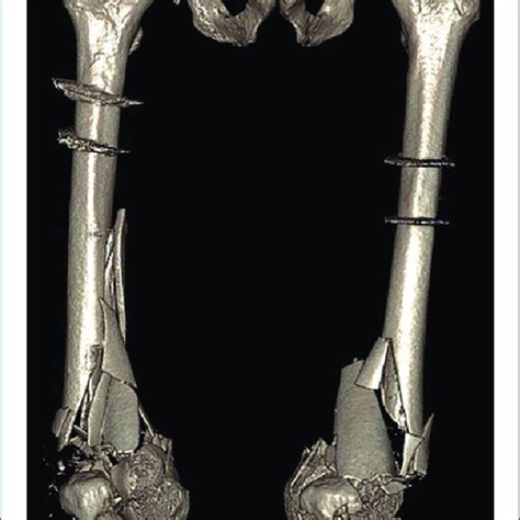 Bilateral distal femur fractures. | Download Scientific Diagram