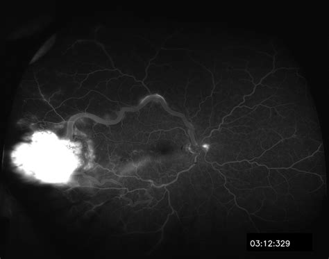 Capillary Hemangioma - Retina Image Bank