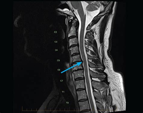 Adult MRI Series - MRI of Cervical spine: Radiculopathy