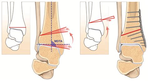 Intra Articular Ligaments Foot