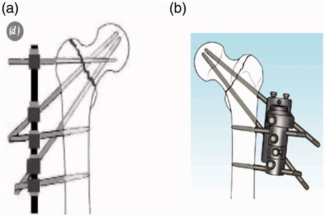 The two main types of external fixators used for treatment of hip ...